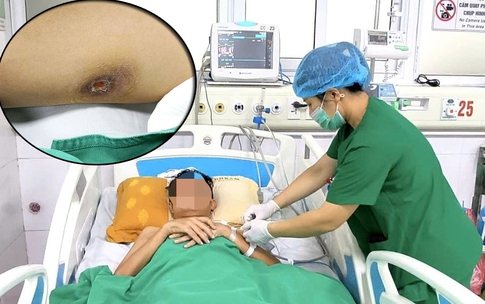 Nam thanh ni&#234;n mắc Whitmore, &#225;p xe đa tạng