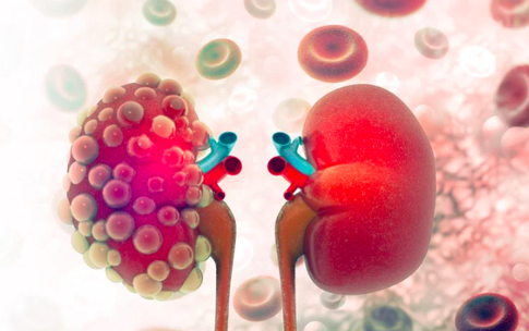 Đau lưng k&#233;o d&#224;i, người đ&#224;n &#244;ng 60 tuổi ph&#225;t hiện ung thư thận hiếm gặp