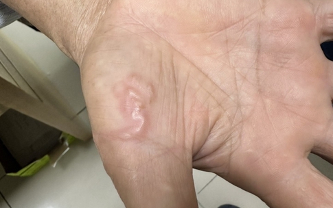 Biểu hiện mắc giun s&#225;n cần đi kh&#225;m sớm, kh&#225;m ở đ&#226;u?