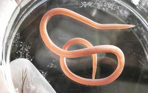 Giun đũa ở người g&#226;y biến chứng nguy hiểm g&#236;, kh&#225;m ở đ&#226;u?