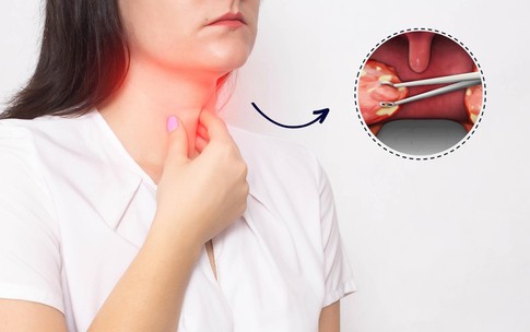 Lợi &#237;ch v&#224; rủi ro khi cắt amidan