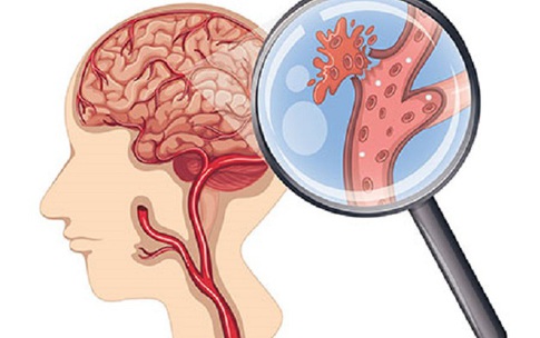 Các dấu hiệu đột quỵ dễ bị bỏ qua khi trời lạnh