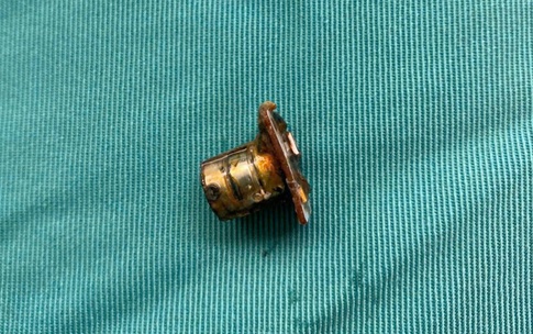 Cụm pin c&#250;c &#225;o trong thực quản b&#233; trai 2 tuổi