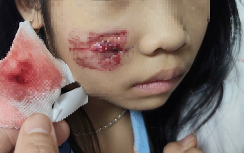 Ch&#225;u b&#233; bị khỉ tấn c&#244;ng g&#226;y vết thương phức tạp v&#249;ng mặt, đầu