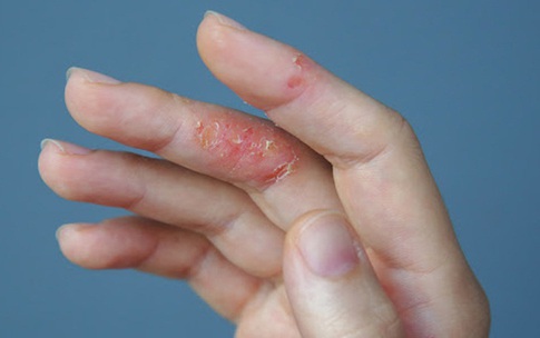 Bệnh vi&#234;m da cơ địa tăng nặng khi thời tiết lạnh, kh&#244;