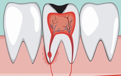 Viêm tủy răng ở trẻ có biểu hiện gì, hệ lụy ra sao?
