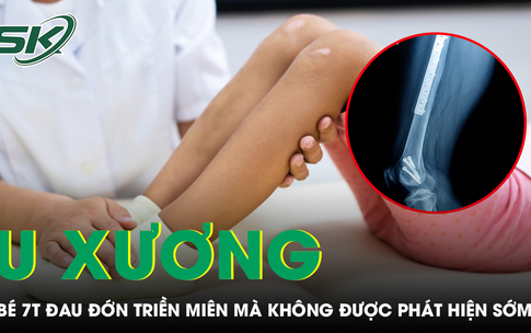 Khối u xương khiến b&#233; 7 tuổi đau triền mi&#234;n, dấu hiệu cha mẹ kh&#244;ng n&#234;n bỏ qua