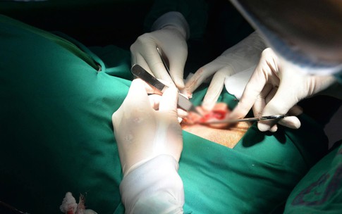 Phẫu thuật thẩm mỹ sẹo, tạo h&#236;nh v&#224;nh tai sau tổn thương do khối u lớn