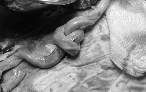 Ph&#225;t hiện d&#226;y rốn bất thường, b&#225;c sĩ kịp thời mổ bắt con, cứu thai nhi tho&#225;t nguy hiểm