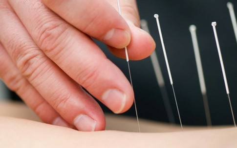 Châm cứu để chữa đau lưng