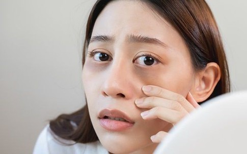 Quầng thâm dưới mắt – Cảnh báo thiếu hụt vitamin và khoáng chất bạn không nên bỏ qua