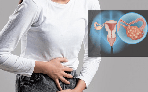 C&#243; thể ph&#225;t hiện sớm ung thư buồng trứng kh&#244;ng?