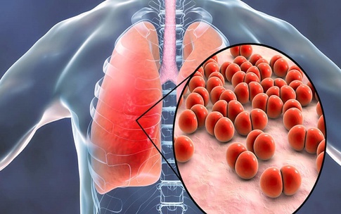 Ho ra m&#225;u cảnh gi&#225;c với bệnh nấm phổi