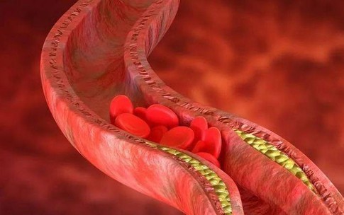 Huyết khối tĩnh mạch s&#226;u nguy hiểm như thế n&#224;o?