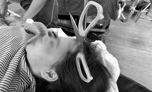 Cô gái 25 tuổi bị kéo nhọn đâm xuyên não
