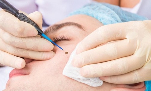Đốt nốt ruồi nhiều lần, người đàn ông bất ngờ nhận tin dữ