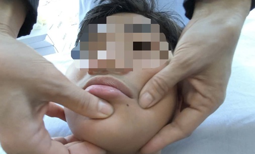 Nhiều ca nhập viện bị liệt mặt, méo miệng do rét đậm