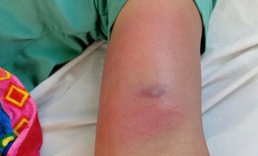 Giun rồng chui dưới da sau nhiều ngày đi rừng uống nước suối