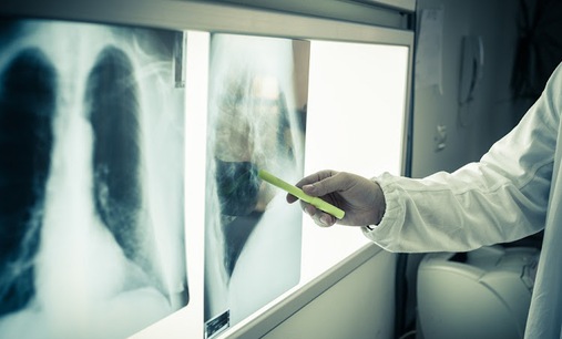 Bộ Y tế: Ưu tiên phân bổ ngân sách địa phương cho công tác phòng, chống lao