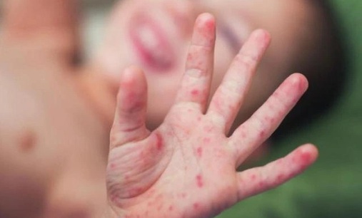 Lâm Đồng giám sát người tiếp xúc gần sau ca bệnh viêm màng não mô cầu