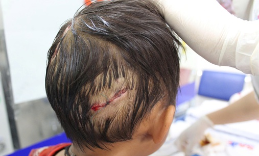 Bé 4 tuổi bị chó nhà cắn, nhiều vết thương nặng ở đầu và tay