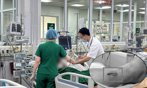 Tái phát uốn ván nguy kịch vì mảnh tre 3cm 'giấu mình' dưới vết thương đã lành