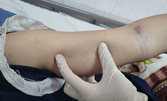 Đắk Lắk: 5 ca tử vong do sốt xuất huyết đều tự ý mua thuốc điều trị