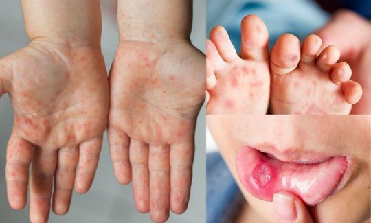 Gần 9.000 ca tay chân miệng, 3 ca tử vong, Bộ Y tế yêu cầu tăng cường phòng chống