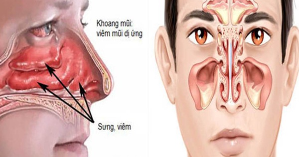 Viêm xoang và viêm mũi dị ứng: Những dấu hiệu cần phân biệt