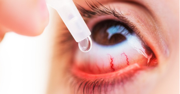 Có những loại thuốc giảm đau mắt nào?
