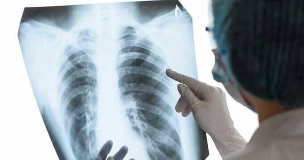 Phân biệt giữa lao kê bệnh học và các loại bệnh phổi