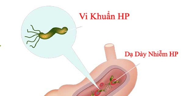 Vi khuẩn HP có liên quan đến ung thư dạ dày không?
