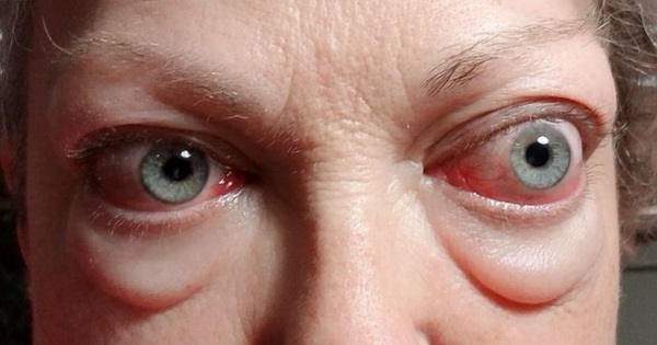 Tại sao mắt lồi lại xảy ra trong bệnh cường giáp?
