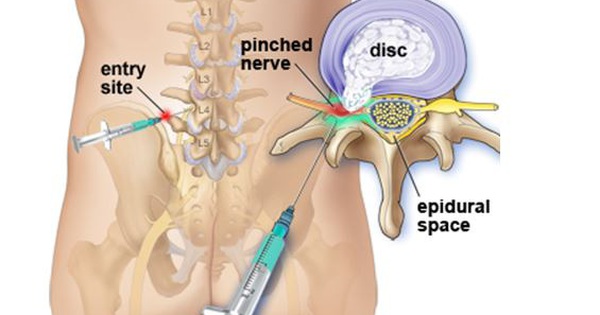Quy trình tiêm cột sống thắt lưng như thế nào?
