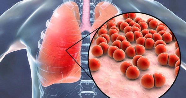 Bệnh phổi kẽ và viêm phổi xơ hóa có khác nhau không?
