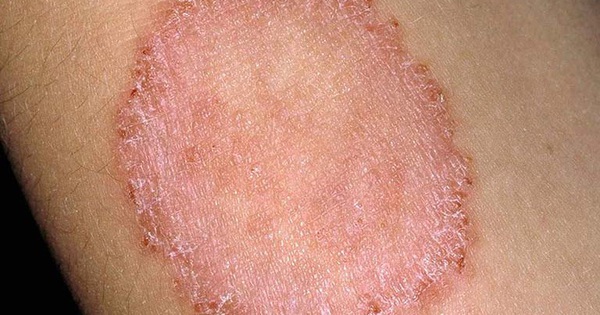 Nấm da là gì và nguyên nhân gây ra bệnh nấm da là gì?
