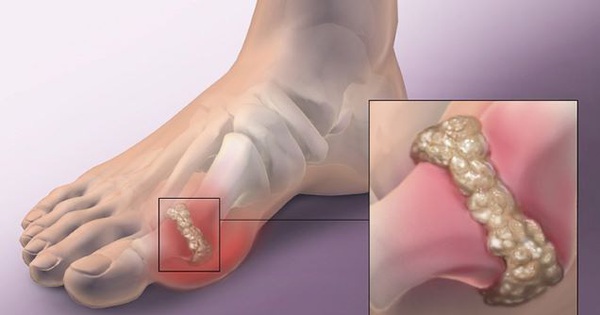 Bệnh gout được coi là bệnh gì trong y học cổ truyền?
