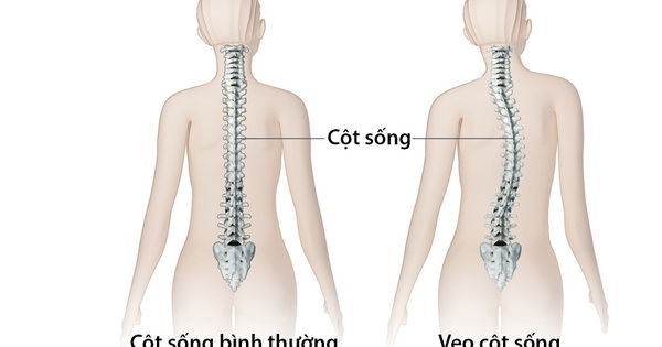 Điều trị vẹo cột sống ở trẻ em bao gồm những phương pháp nào?
