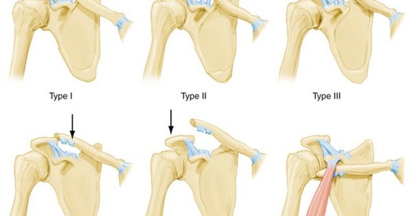  Xương đòn bị nhô cao : Thời gian điều trị và quá trình hồi phục