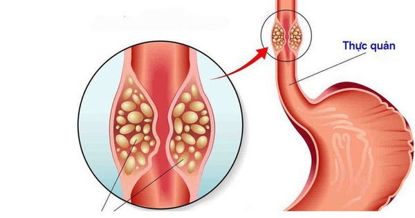 Hóa trị được sử dụng như một phương pháp điều trị ung thư thực quản?
