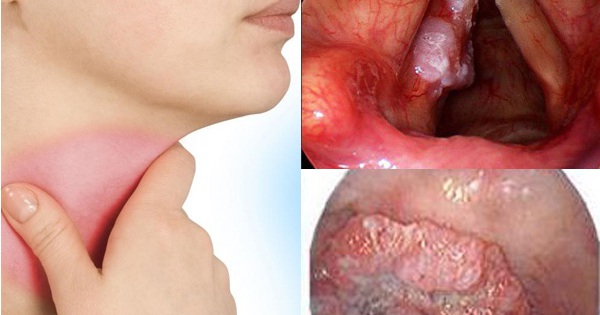 Có yếu tố nào khác có thể gây ra cảm giác nghẹn cổ họng và khó thở trong ung thư thanh quản?
