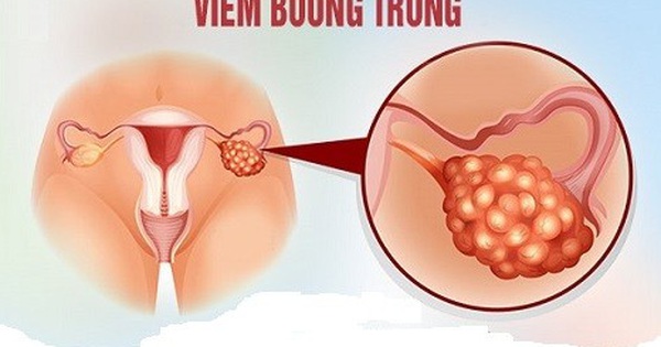 Cách phát hiện và chẩn đoán viêm buồng trứng như thế nào?
