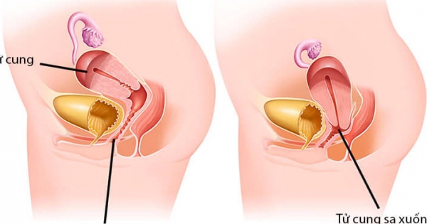 Thuốc nội tiết tố nữ đặt âm đạo là gì?
