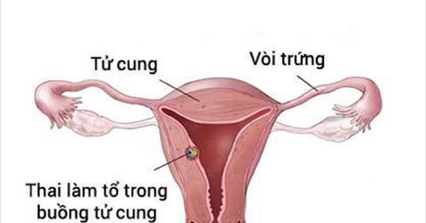 Các thủ tục và phương pháp xác định thai vào tử cung?
