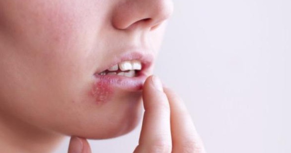 Các biện pháp chữa trị nào hiệu quả nhất cho mụn rộp sinh dục miệng?
