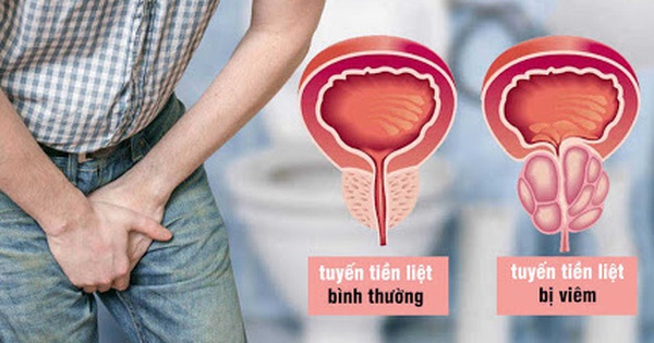 Thuốc giảm đau và chống viêm được sử dụng trong điều trị viêm tuyến tiền liệt như thế nào?
