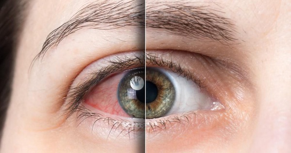 Làm thế nào để chăm sóc mắt để tránh khô mắt?