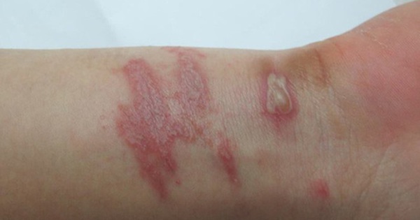 Kiến ba khoang đốt gây tổn thương trên da như thế nào?
