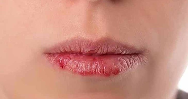 Triệu chứng của chàm môi như thế nào?
