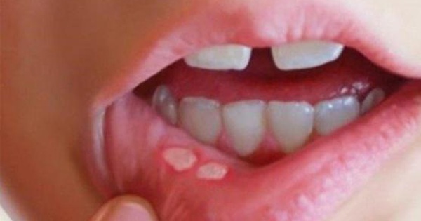 Lở loét miệng có phải là triệu chứng chính của HIV không?